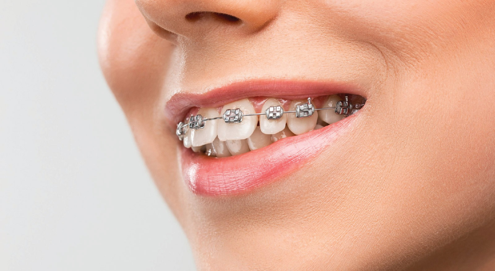 Braces