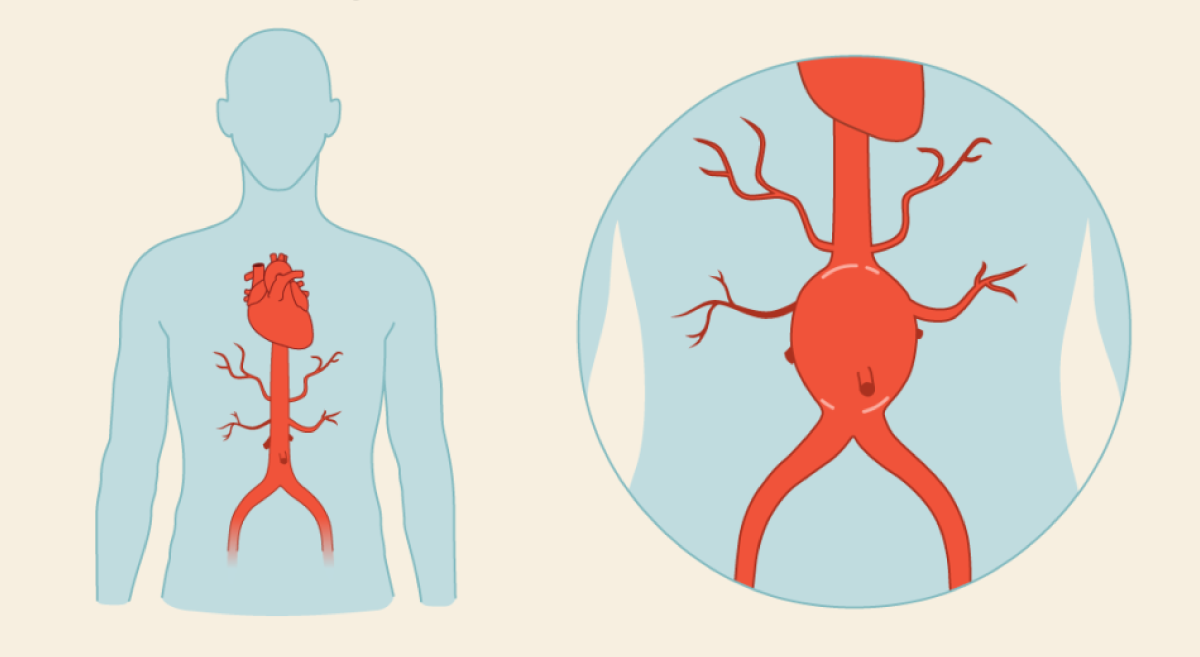 Understanding-Abdominal-Aortic-Aneurysms-(AAA)
