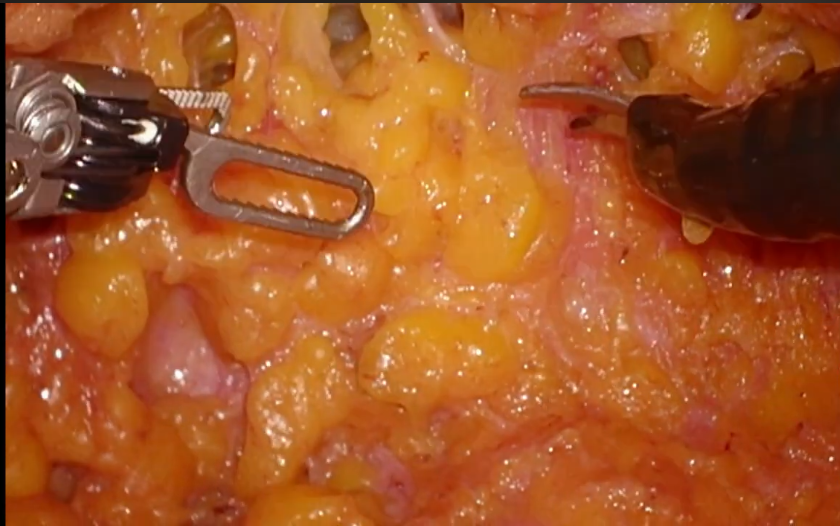 Breast Carcinoma 3