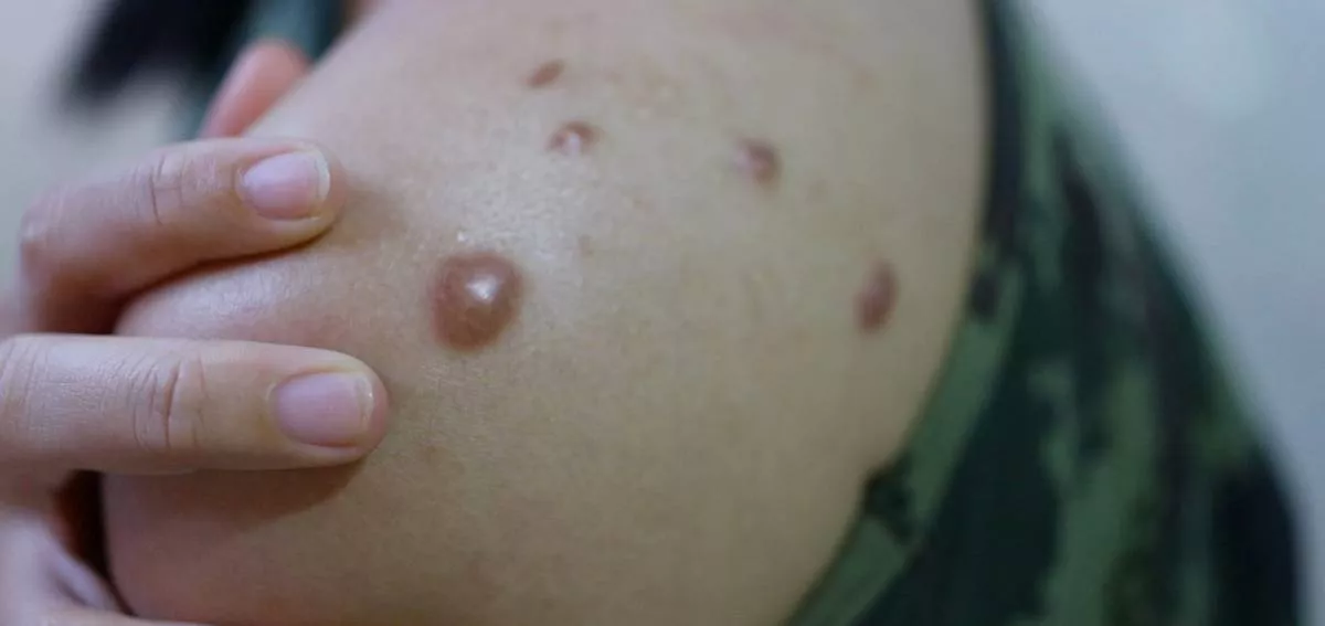 monkey-virus-symptoms-&amp;-treatment