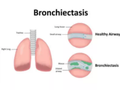 Bronchiectasis