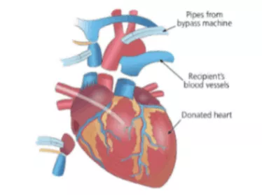 Heart &amp; Double lung transplantation