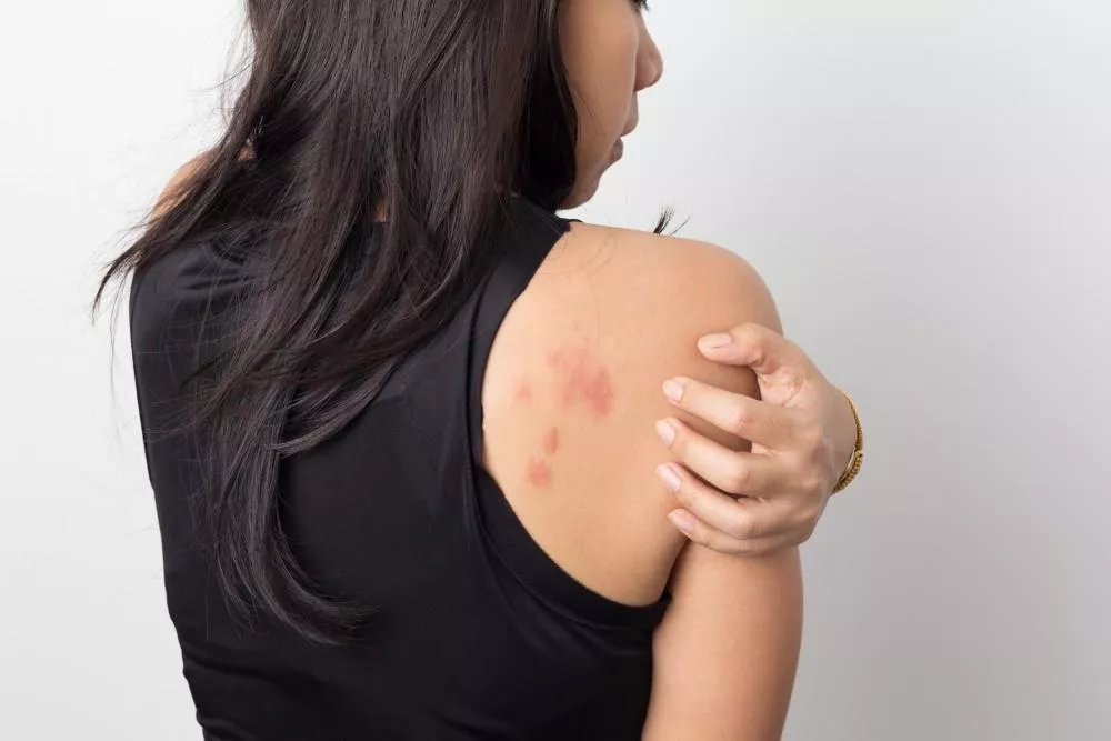 Hives