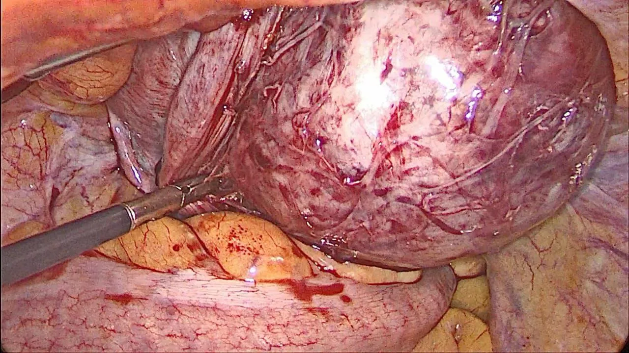 myomectomy 3