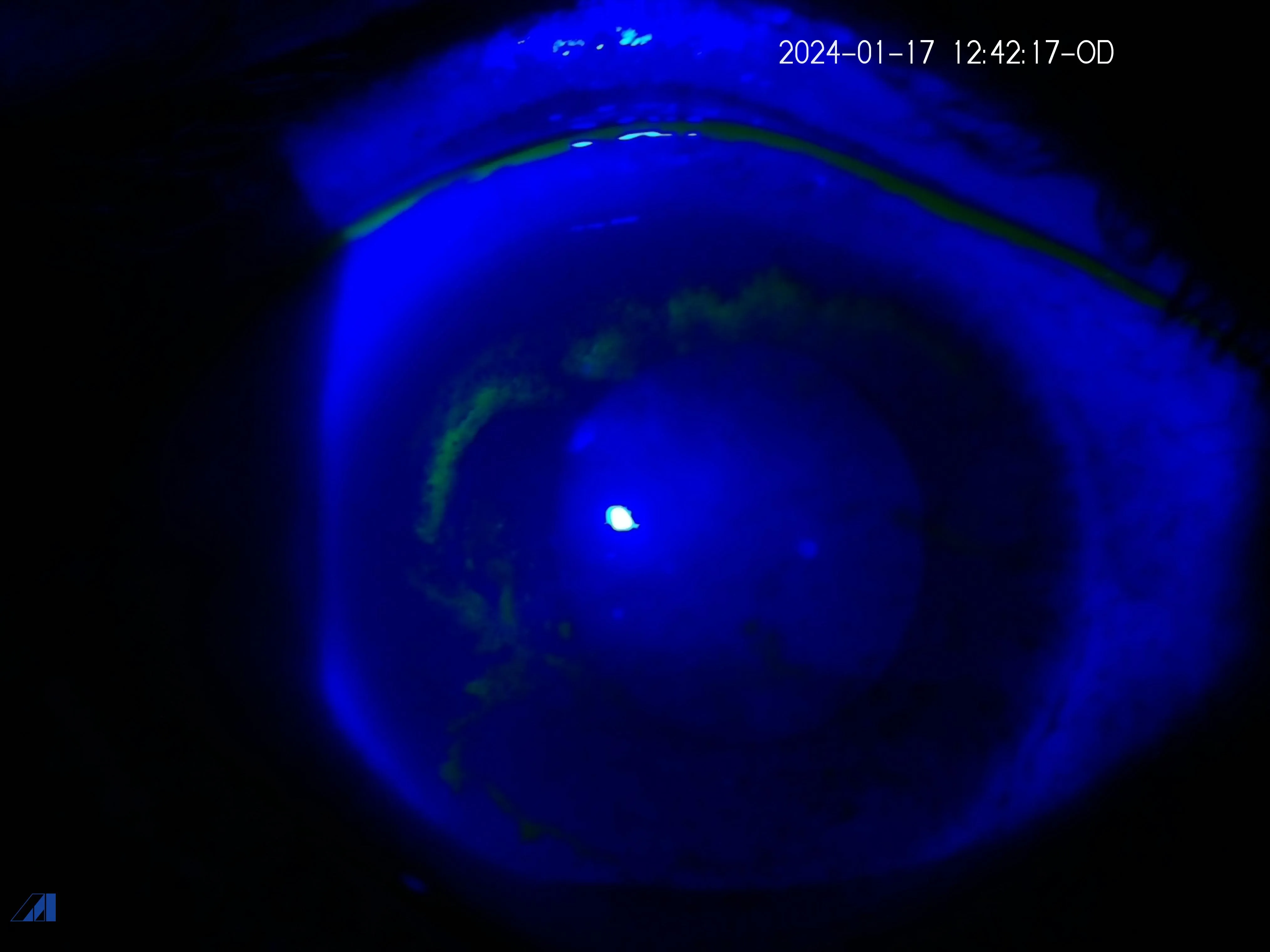 Migratory Corneal 3