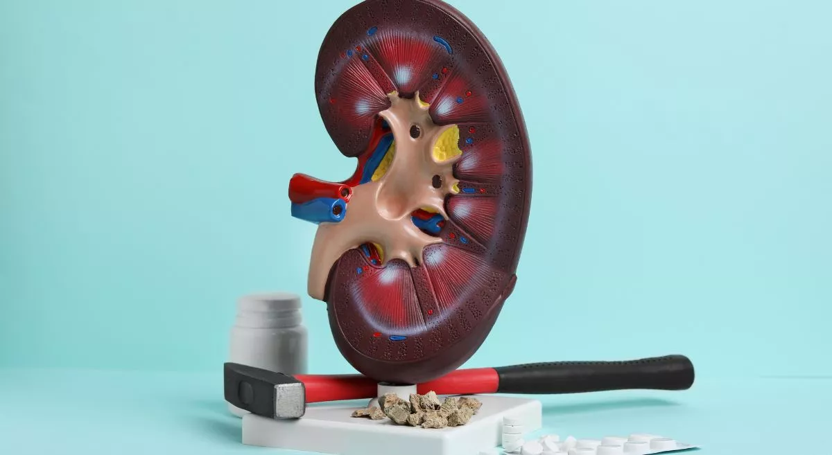 What Are Kidney Stones?