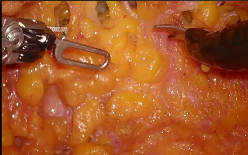 Breast Carcinoma 3