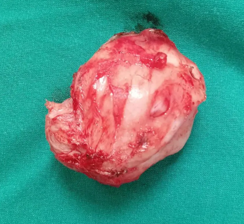 Caesarean myomectomy