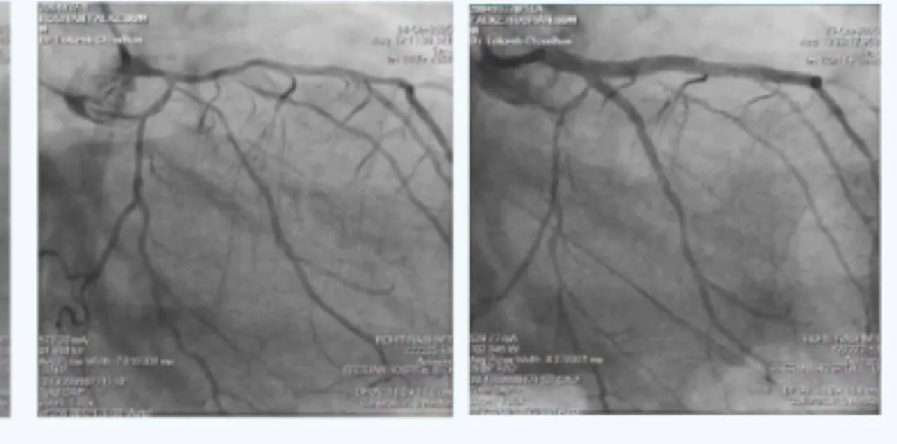 Acute Coronary Syndrome in a Patient with Multiple Comorbidities 1